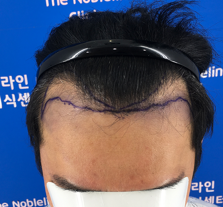수술해보니 엠자는 꼭 고밀도로 심어야 합니다.