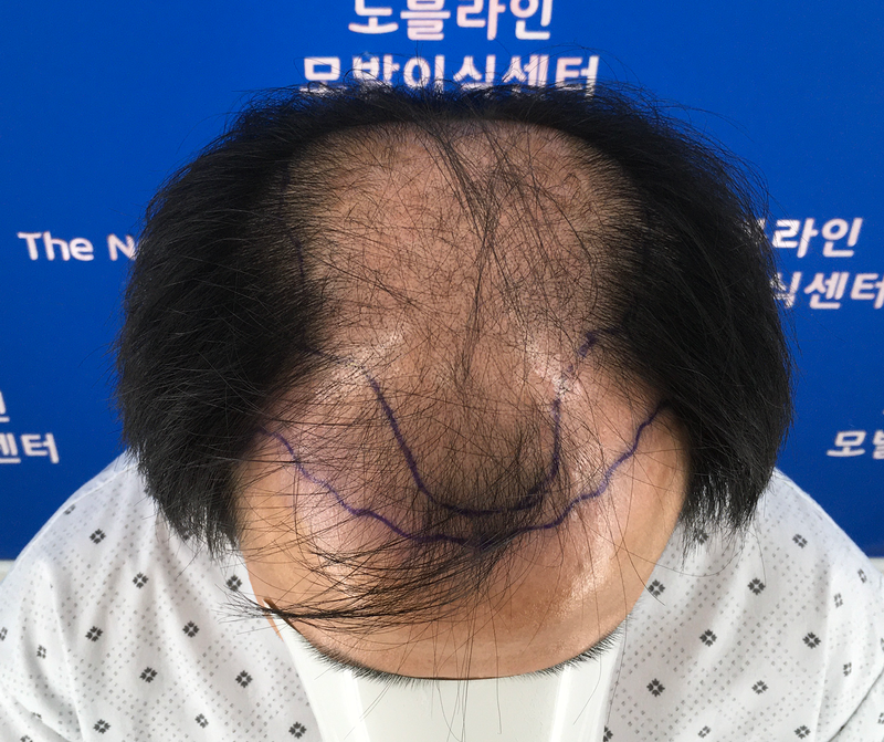 어느덧 3개월, 요즘에는 모자 벗고 당당하게 외출 합니다.