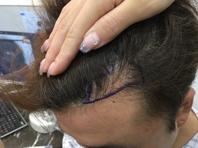 진짜 모발이식은 신세계네요.