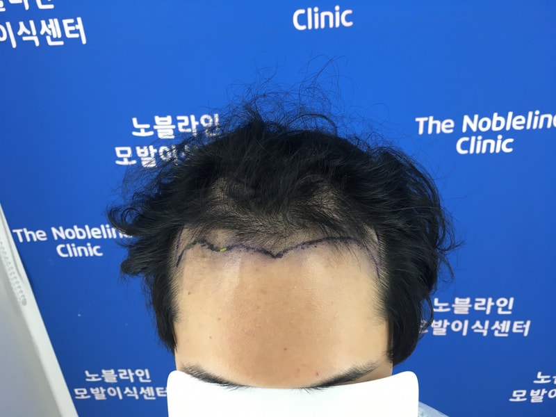 I overcame my family's opposition and underwent surgery.