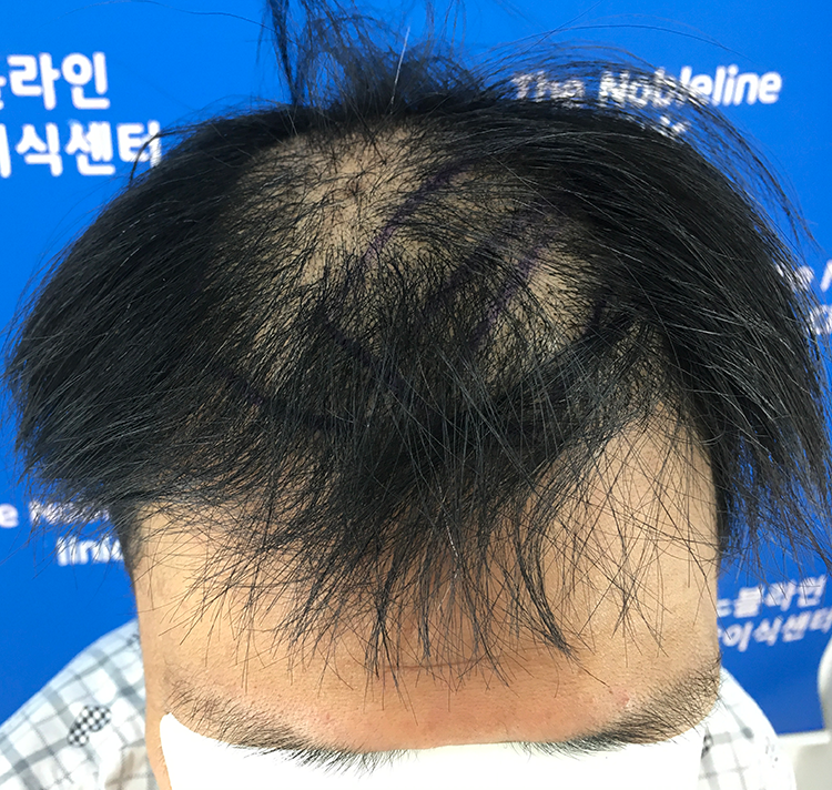 I had a mass hair transplant of 9040 hair.