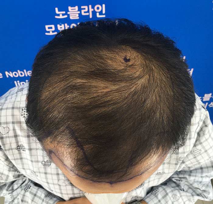 만모 대량이식 200일차