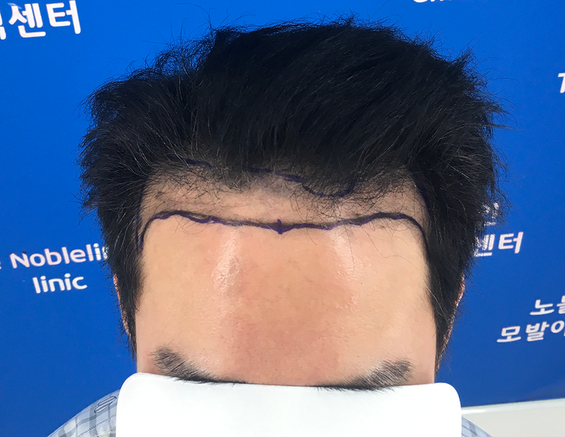 Planting hair and psychological changes are really big!