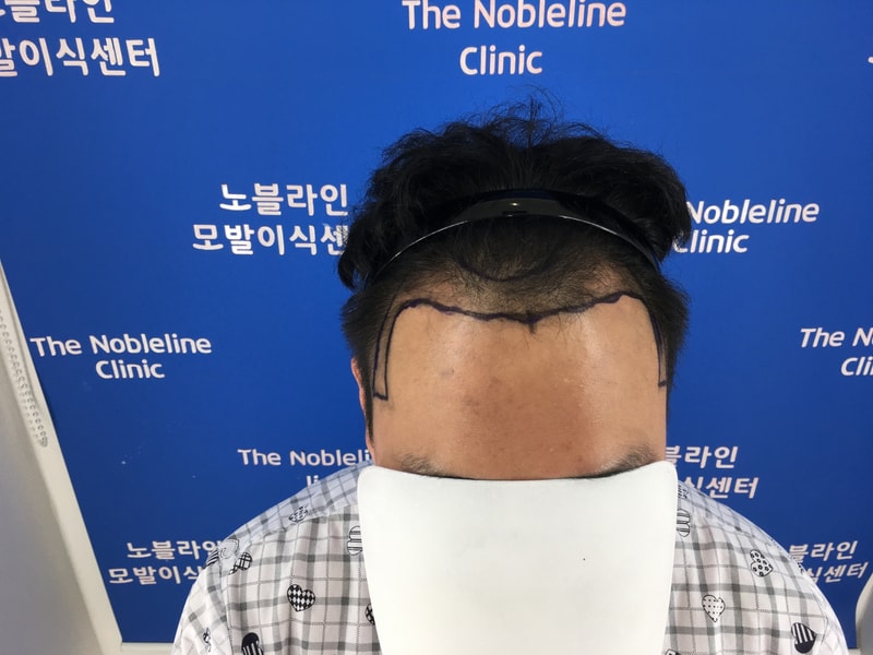 노블라인에서 1년 기다려 드디어 수술 했습니다!