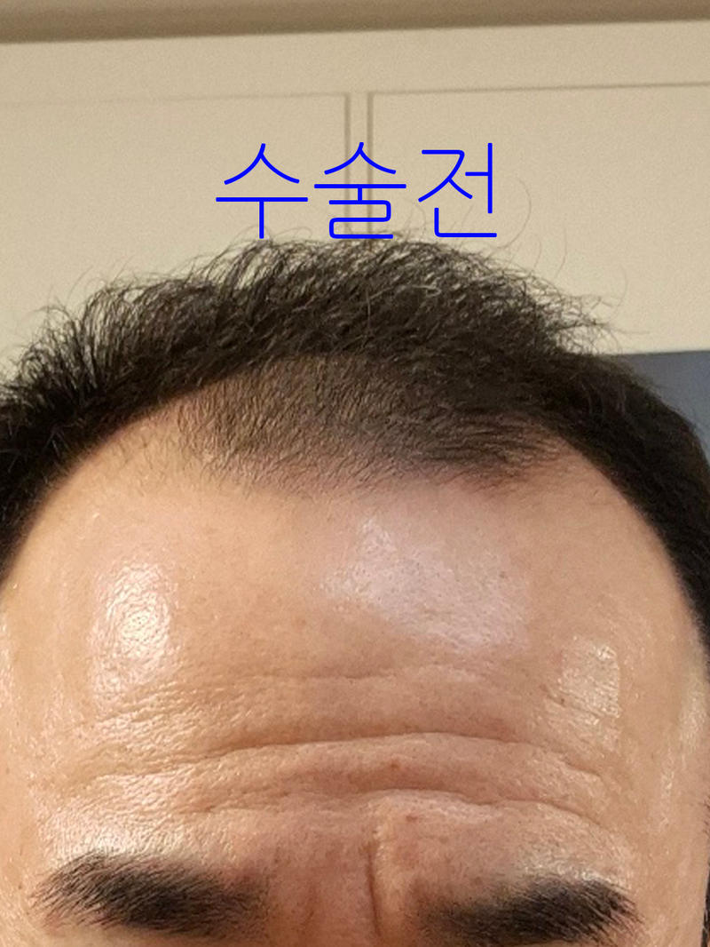 남자는 머릿빨! 4개월과 7개월 비교합니다.