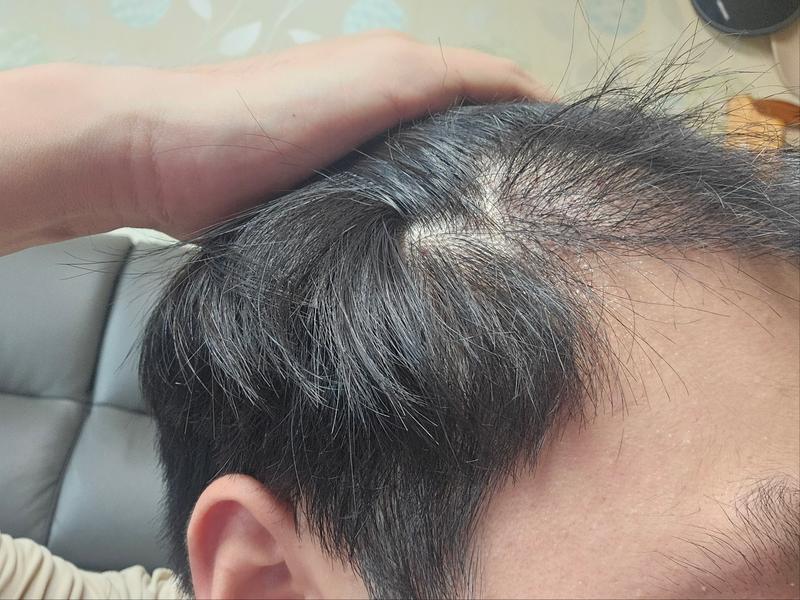 Day 94 of hair transplant