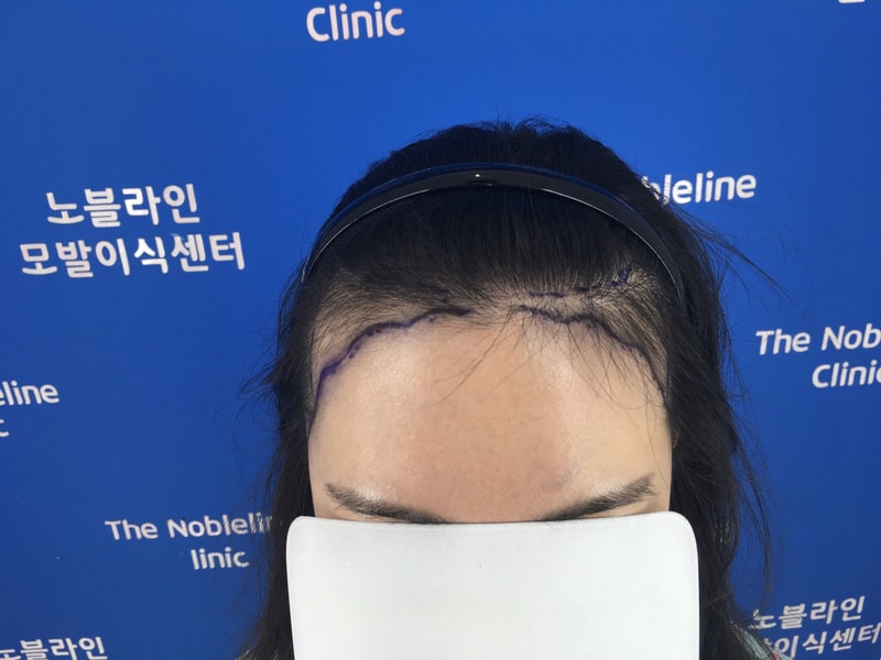 여자 M자 수술 후기