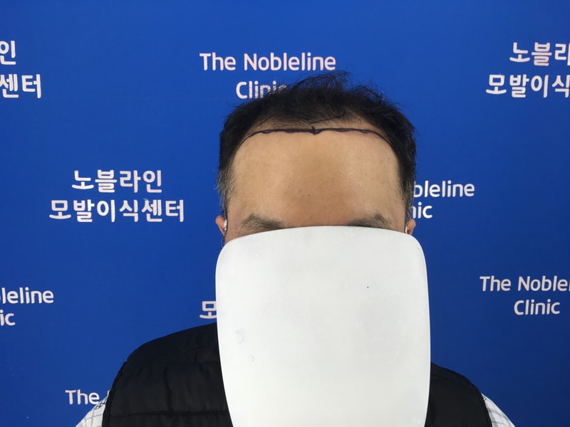 백현욱 원장님이 직접 집도해주셔서 믿음을 가지고 수술했습니다.
