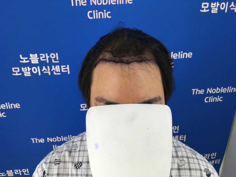 배냇머리 같이 올라오는 90일차 모발이식러!