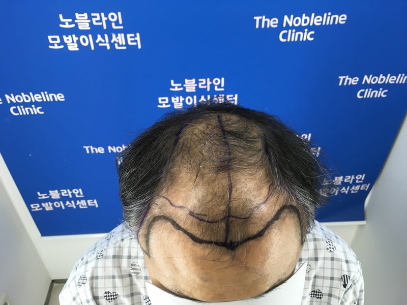 대량모발이식으로 9249모 심었습니다.
