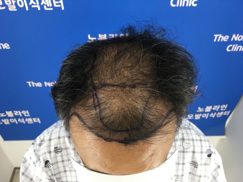 8951모 대량이식 암흑기가 한참 진행중이지만 견딜만 합니다.