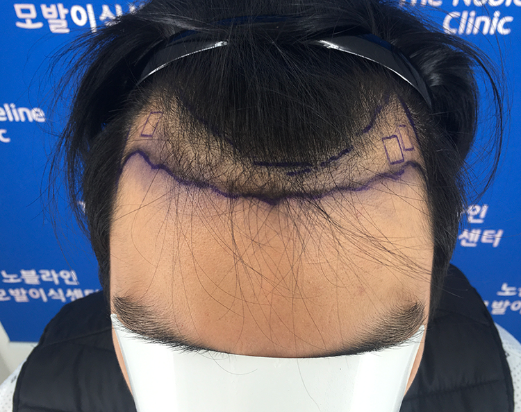 Day two of hair transplant surgery