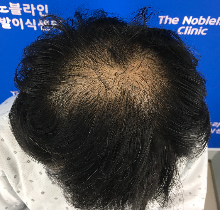 10th day of crown density reinforcement