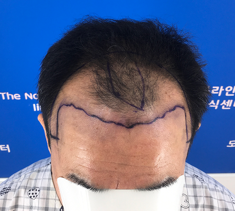 노블라인에서 수술했습니다.