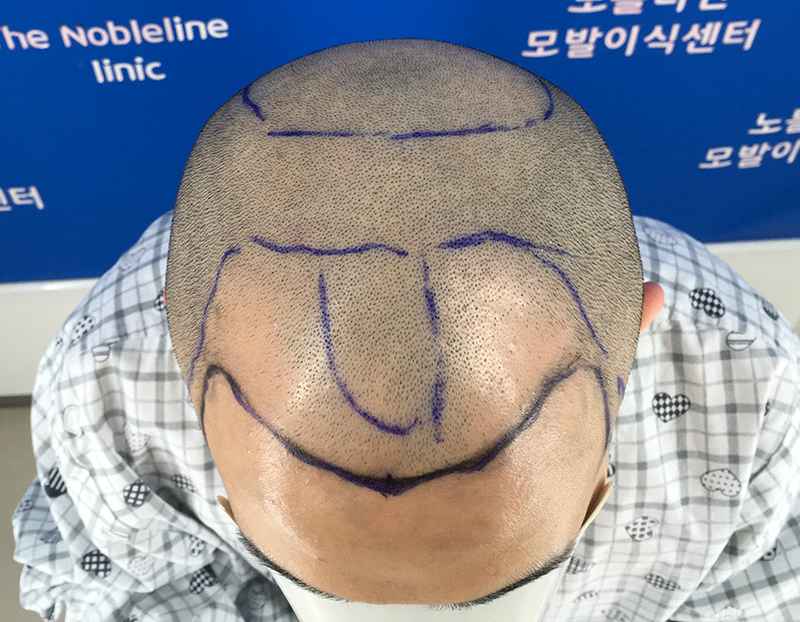 7580모 대량이식 3개월 입니다.