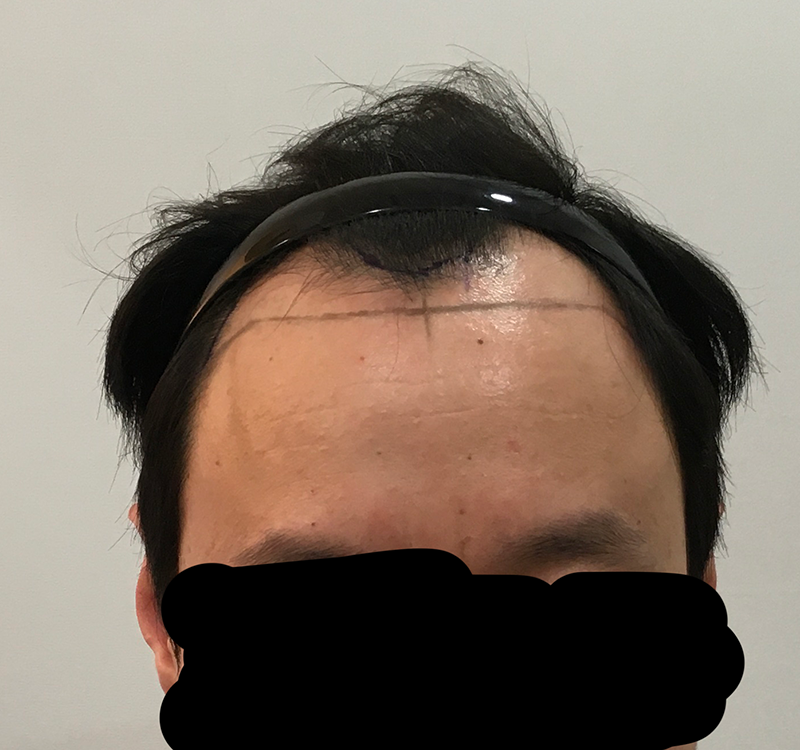 日本から飛んできて植毛した甲斐があります。