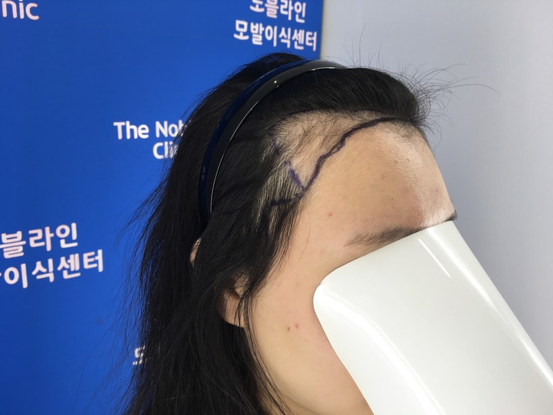 헤어라인 예뻐지고 있어요.