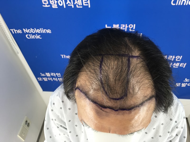 3개월 되었습니다. 모발이식 하실 분들 백원장님 라방 꼭 한번 들어가 보십쇼.