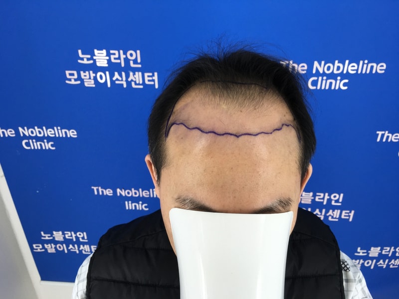 만모이식 아홉달째 후기 (중간경과)