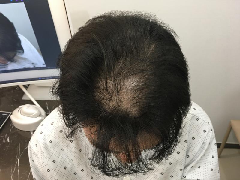 I finally filled the empty top of my head. (Second surgical instrument)