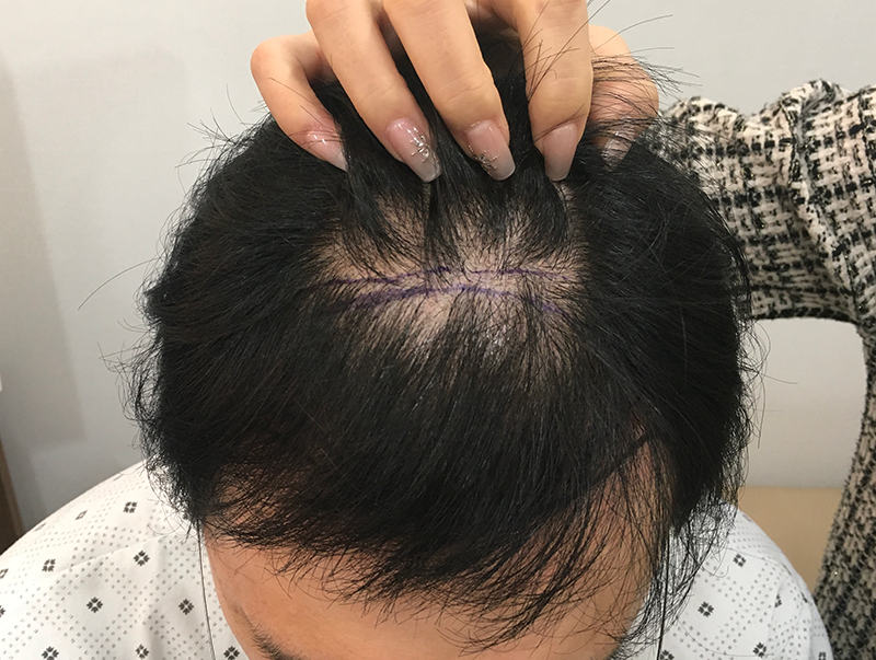 재수술로 뒷머리 부족한 분들도 희망이 있습니다. (재수술 6개월차 입니다.)