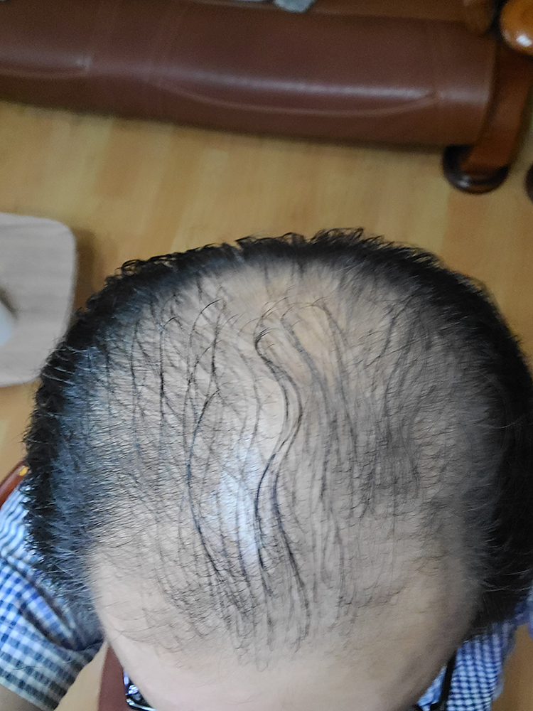 Three-month review of mass hair transplantation