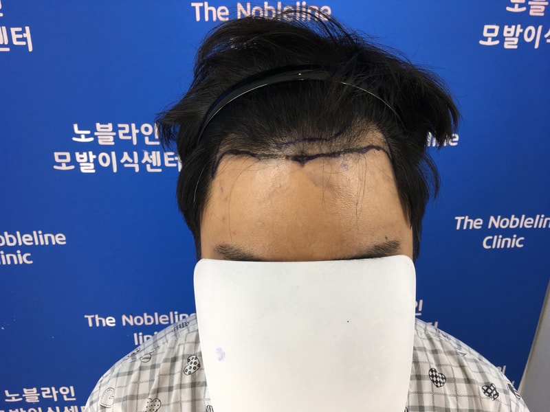 長年のファンでベク·ヒョンウク院長に手術を受けました。