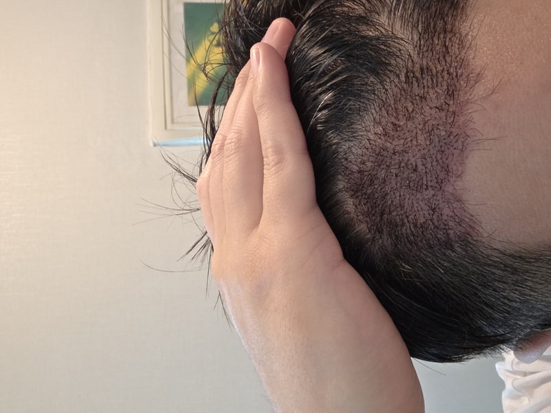 머리 심었습니다. 잘 자라고 있고 암흑기 없이 지나가고 싶습니다.