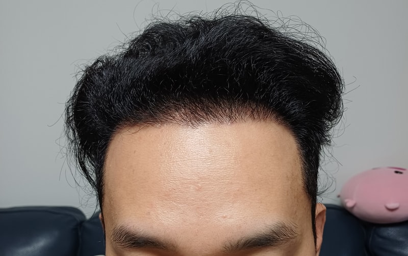 I lowered my forehead by 2 centimeters and it's growing well.