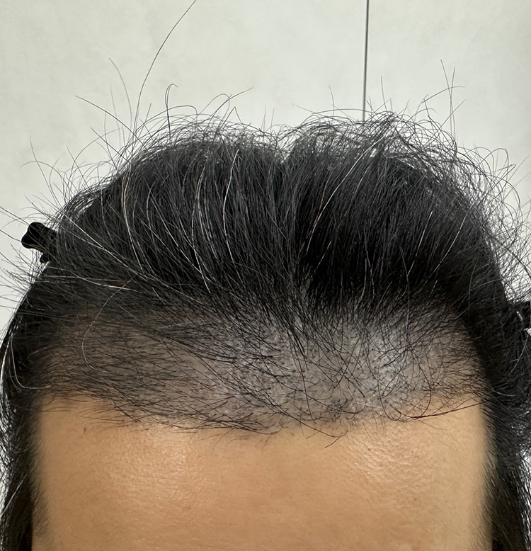 Day 100 progress shared (with pictures of the back and sides)