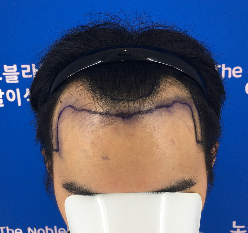 머리심은지 17일째에요.