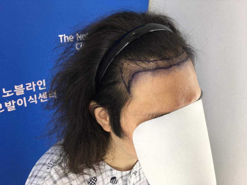 지인에게 소개받고 노블라인에서 수술했습니다.