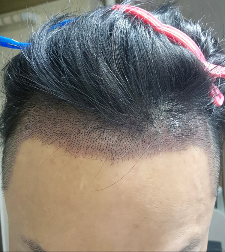 수술 12일차