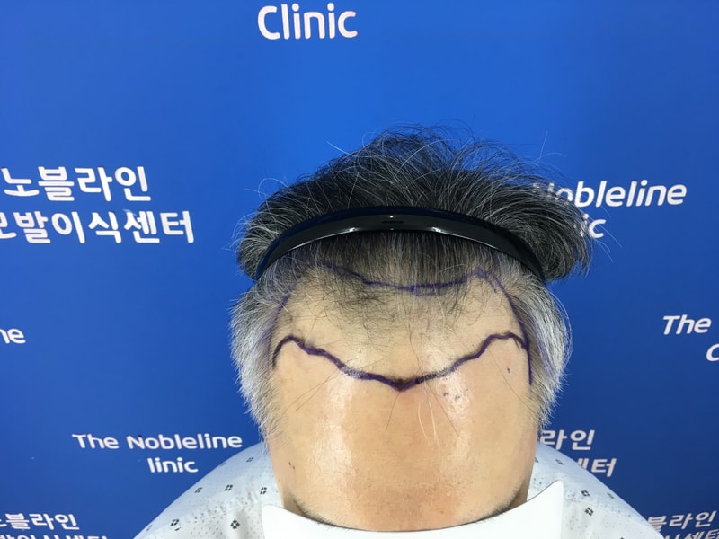 파이팅 넘치는 백원장님에게 수술받았습니다.