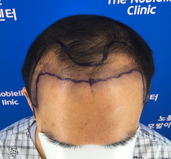 만모 대량이식 130일차