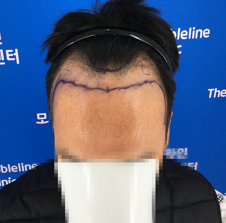 백현욱원장님 덕분에 머리 스트레스 안 받고 잘 지내고 있습니다.