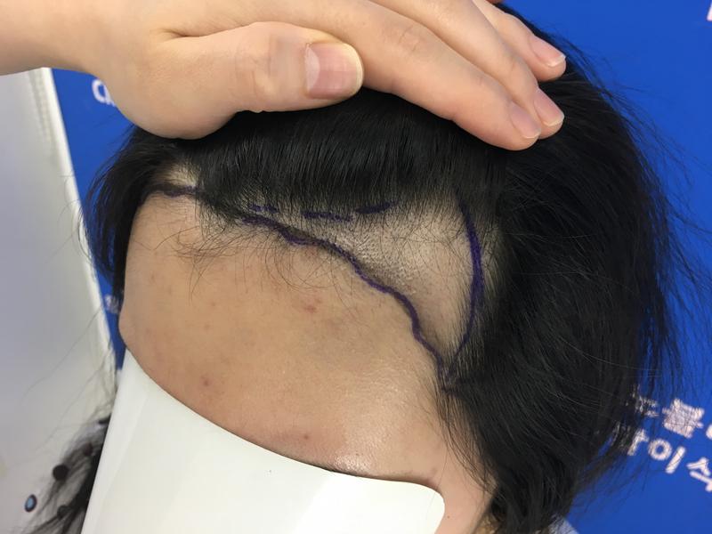 从Nobline移植了发际线。