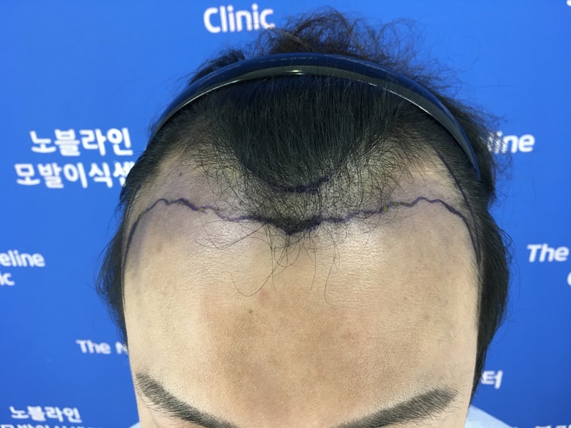 M자 모발이식 15개월이 지났습니다. 졸업후기 올립니다.