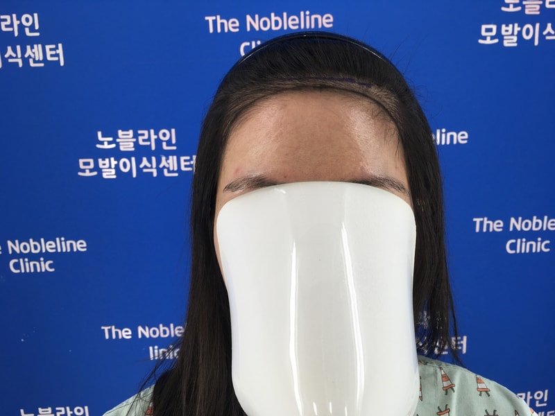 노블라인의원에서 헤어라인 했어요.