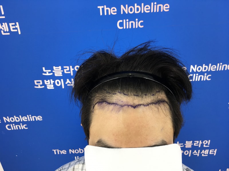 한국가서 모발이식 했습니다.