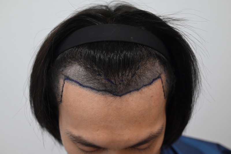 수술전디자인.jpg