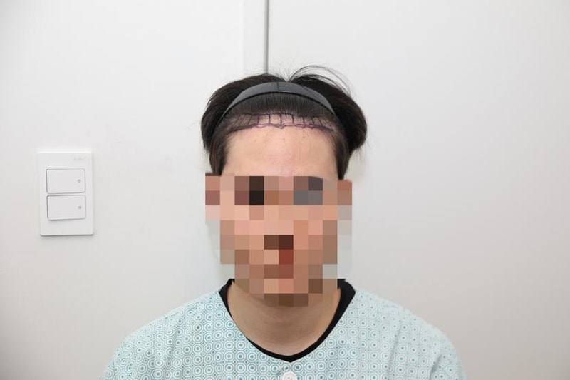 모발이식 6개월차 후기