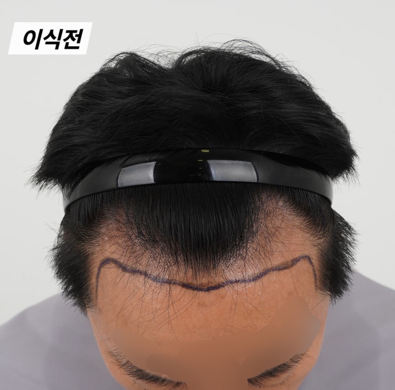 모발이식 후기
