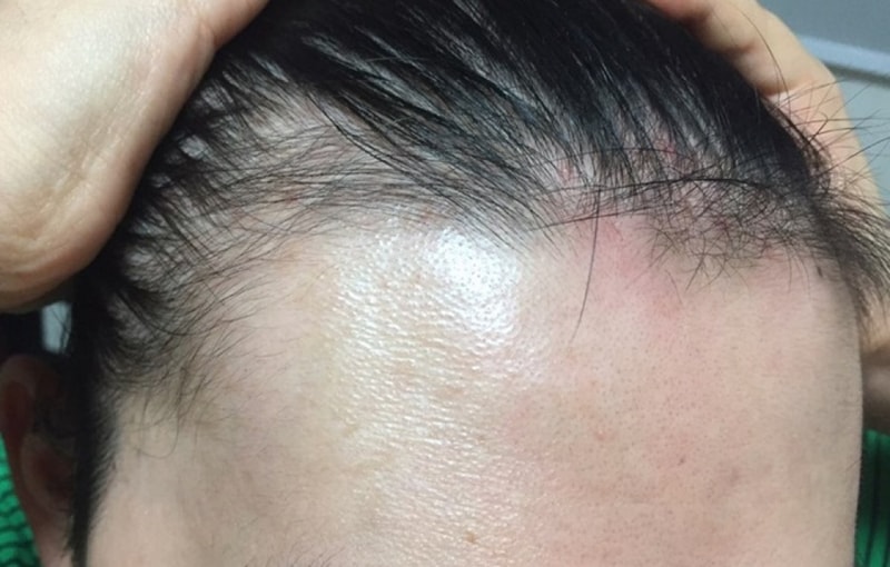 I had forehair surgery I'm going to post a review