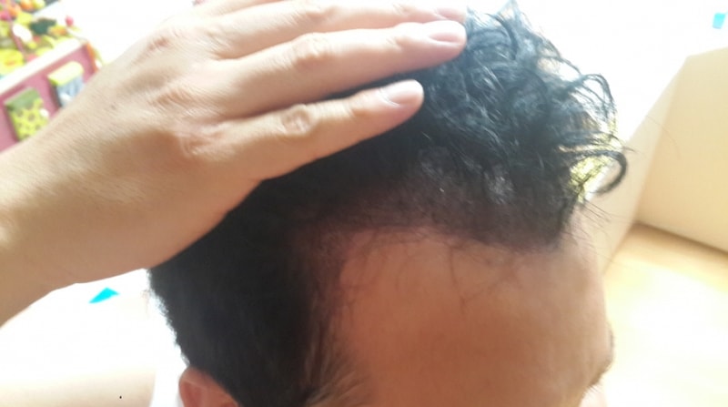 FORHAIR 1300毛囊非切开手术后自拍后记