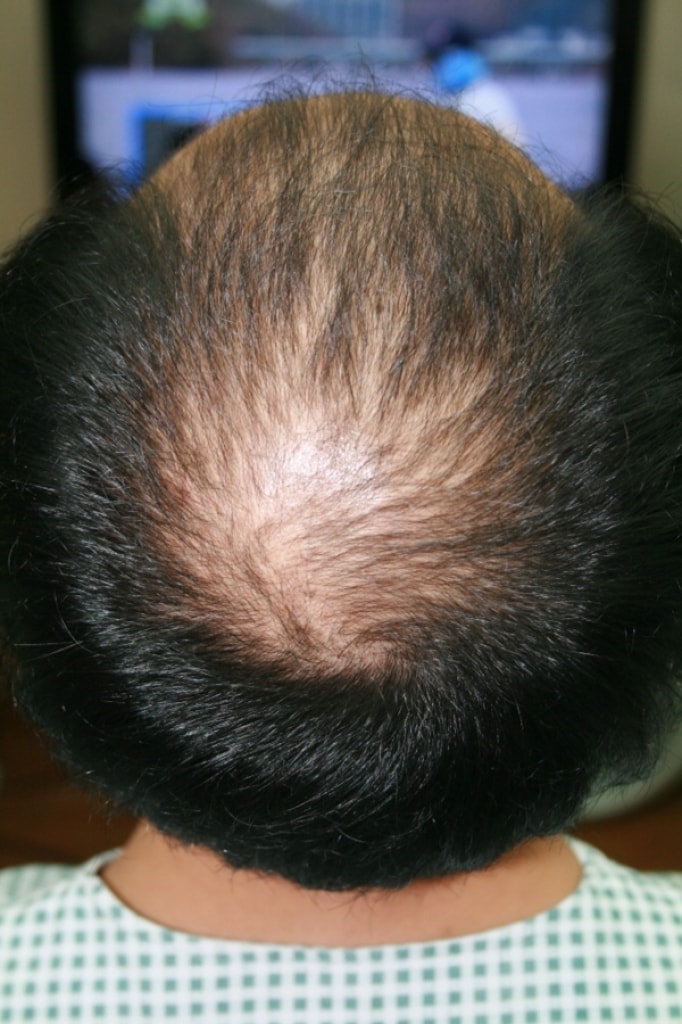 Forehead + top of the head hair transplant has been over 200 days.