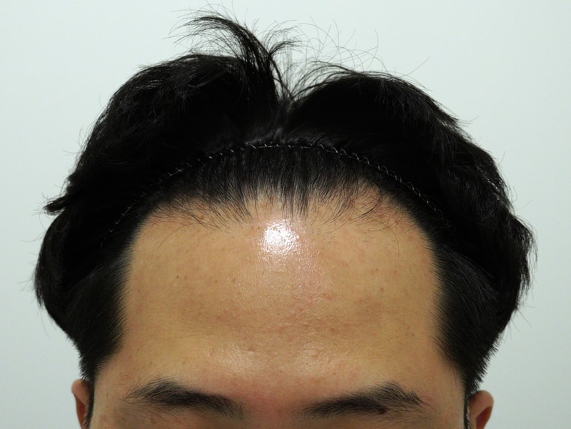 How do I look a year after 3300 hair incision hair transplant