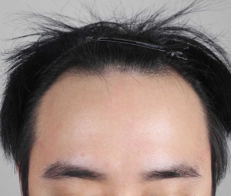 헤어라인 전.jpg