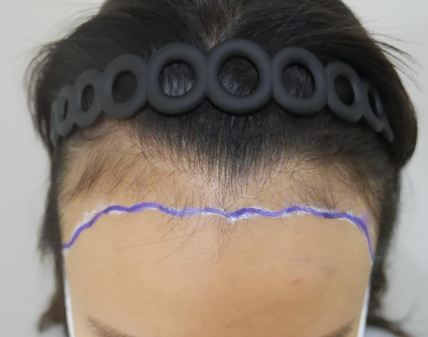 ヘアラインの毛髪移植にとても満足しています(笑)