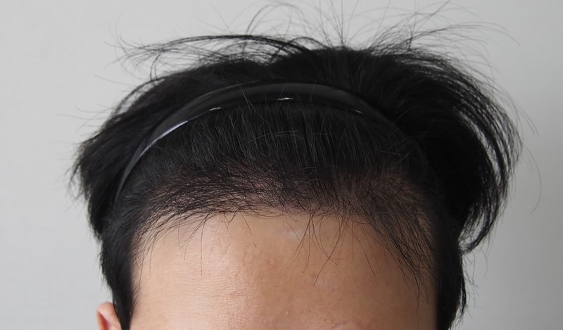 Late stage at 4th month of maternal 1600 follicle transplantation